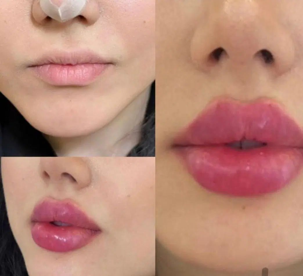تزریق چربی،ژل،بوتاکس ونخ و مادلینگ تخصصی توسط پزشک|خدمات آرایشگری و زیبایی|کرمانشاه, |دیوار
