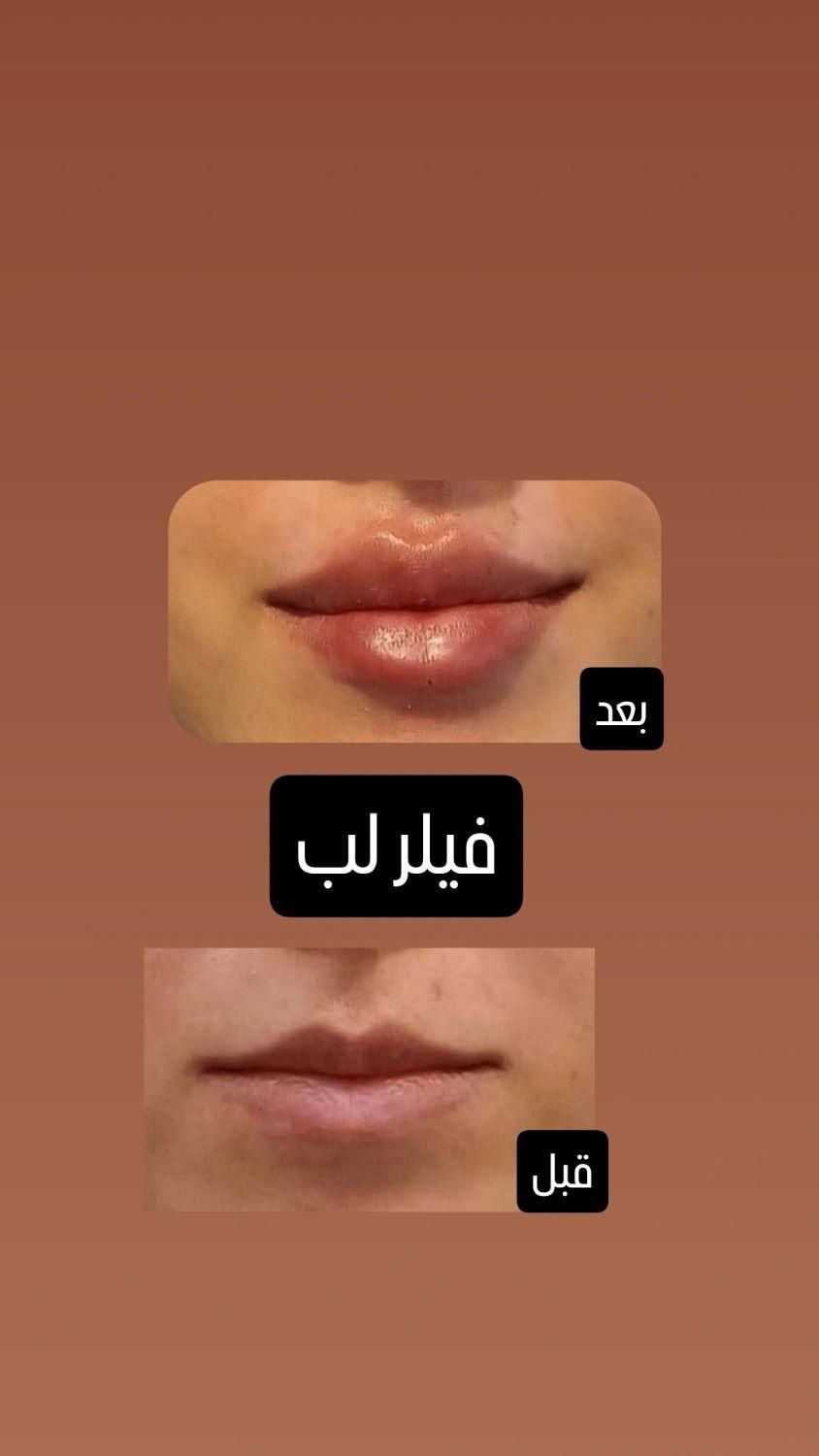 تزریق ژل وبوتاکس با بهترین قیمت در برازجان|خدمات آرایشگری و زیبایی|برازجان, |دیوار