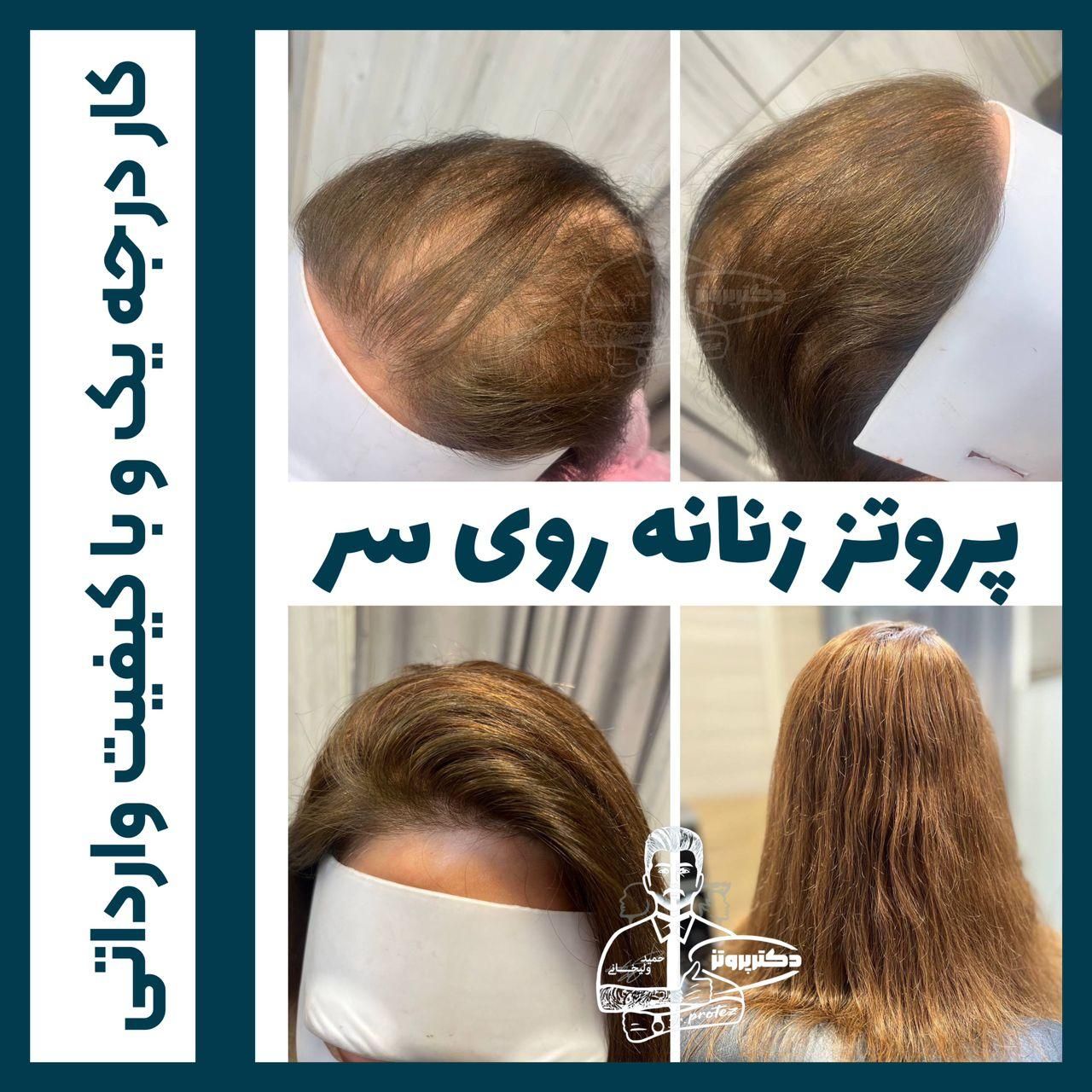 پروتزمو (دکترپروتز)|خدمات آرایشگری و زیبایی|اصفهان, هزارجریب|دیوار
