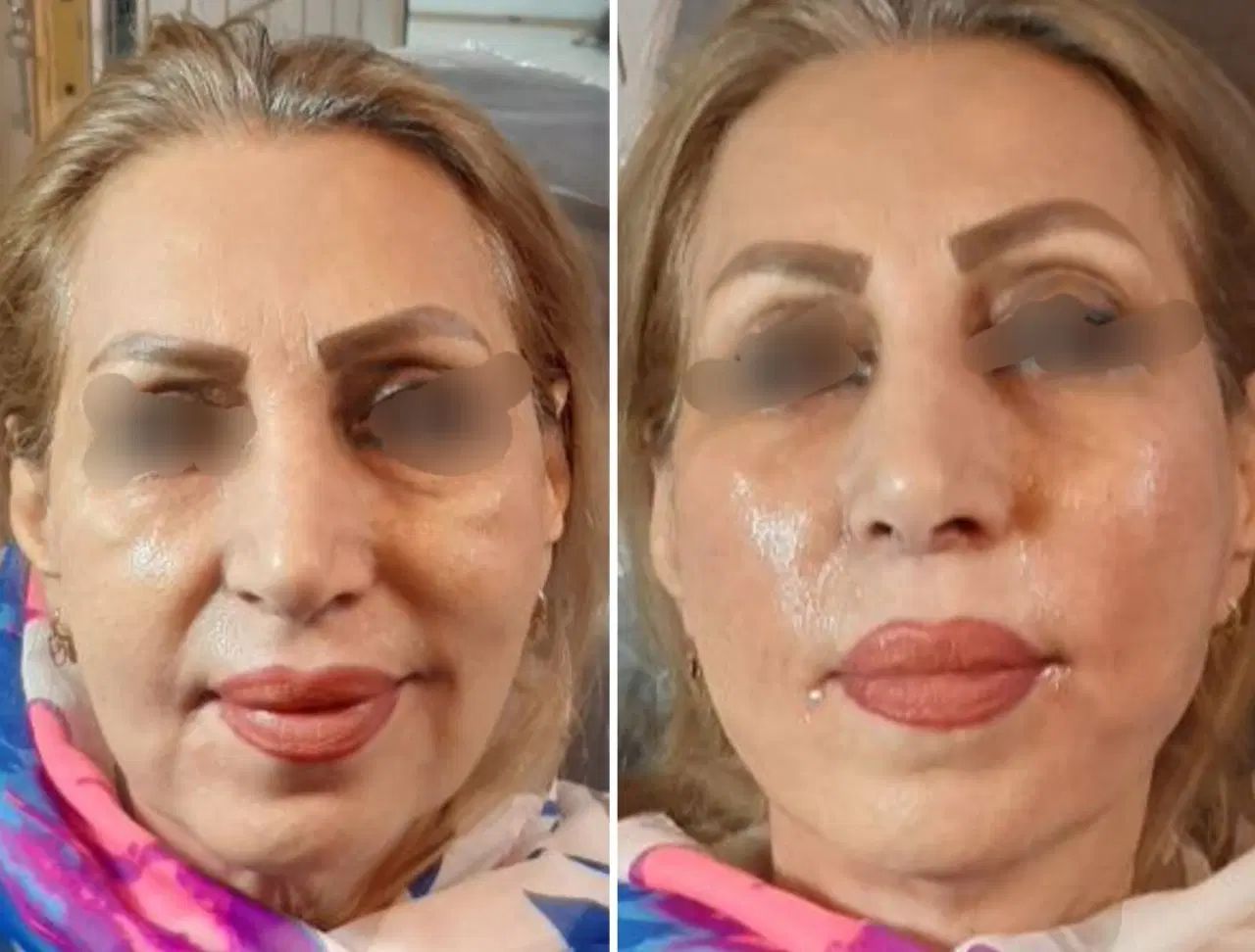 عمل لیفت ابرو وشقیقه جراحی ۸م بوتاکس مصپورت ۶۰۰|خدمات آرایشگری و زیبایی|مشهد, شهید فرامرز عباسی|دیوار