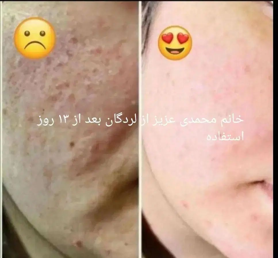 با این کرم فقط با ده روز پوستت رو فوق العاده کن|آرایشی، بهداشتی، درمانی|لردگان, |دیوار