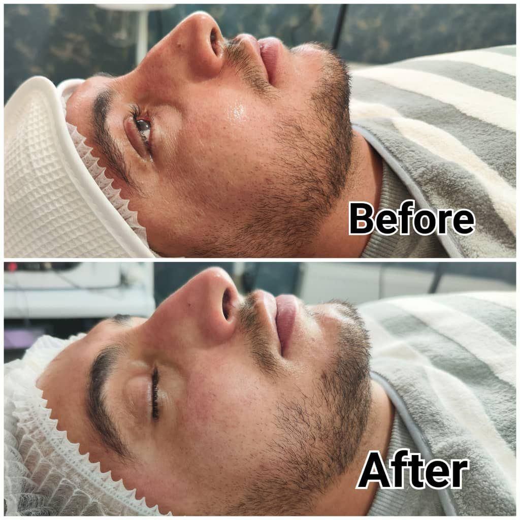 فیشیال تخصصی/پاکسازی پوست/ اسکین کر/پیلینگ شیمیایی|خدمات آرایشگری و زیبایی|شیراز, زند|دیوار
