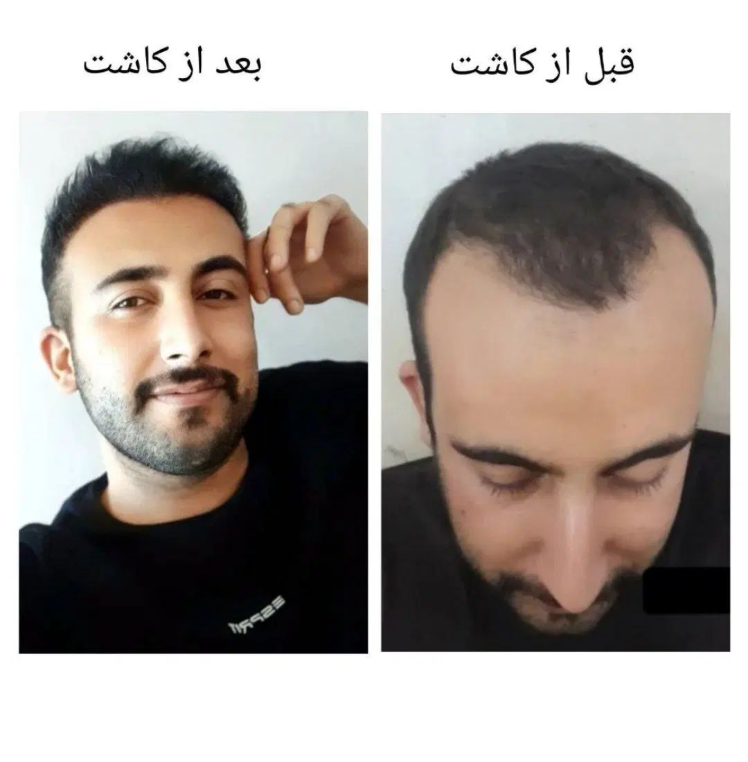 بیا اقساطی مو بکار کاشت مو و ابرو و ریش تضمینی|خدمات آرایشگری و زیبایی|ارومیه, |دیوار
