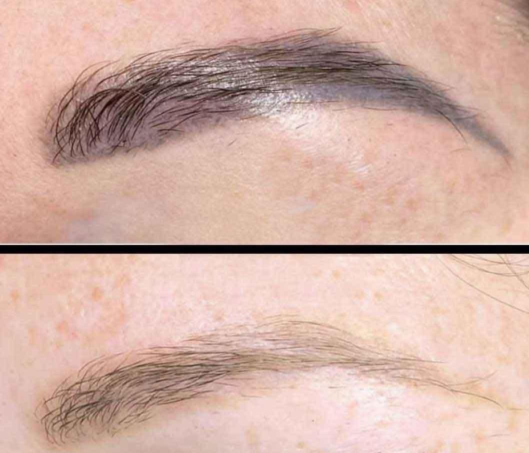 حذف انواع تاتو و خالکوبی با کیوسوئیچ|خدمات آرایشگری و زیبایی|برازجان, |دیوار