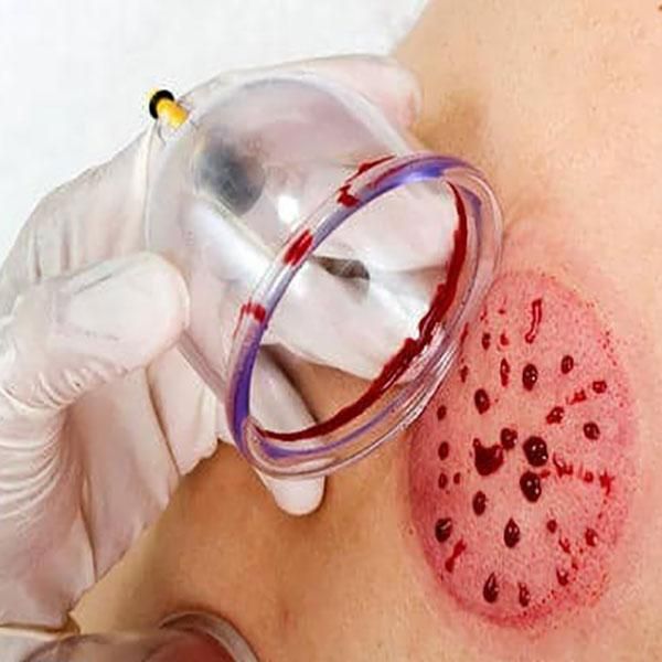 حجامت، فصد خون، زالو درمانی در منزل|خدمات آرایشگری و زیبایی|پرند, فاز ۵|دیوار