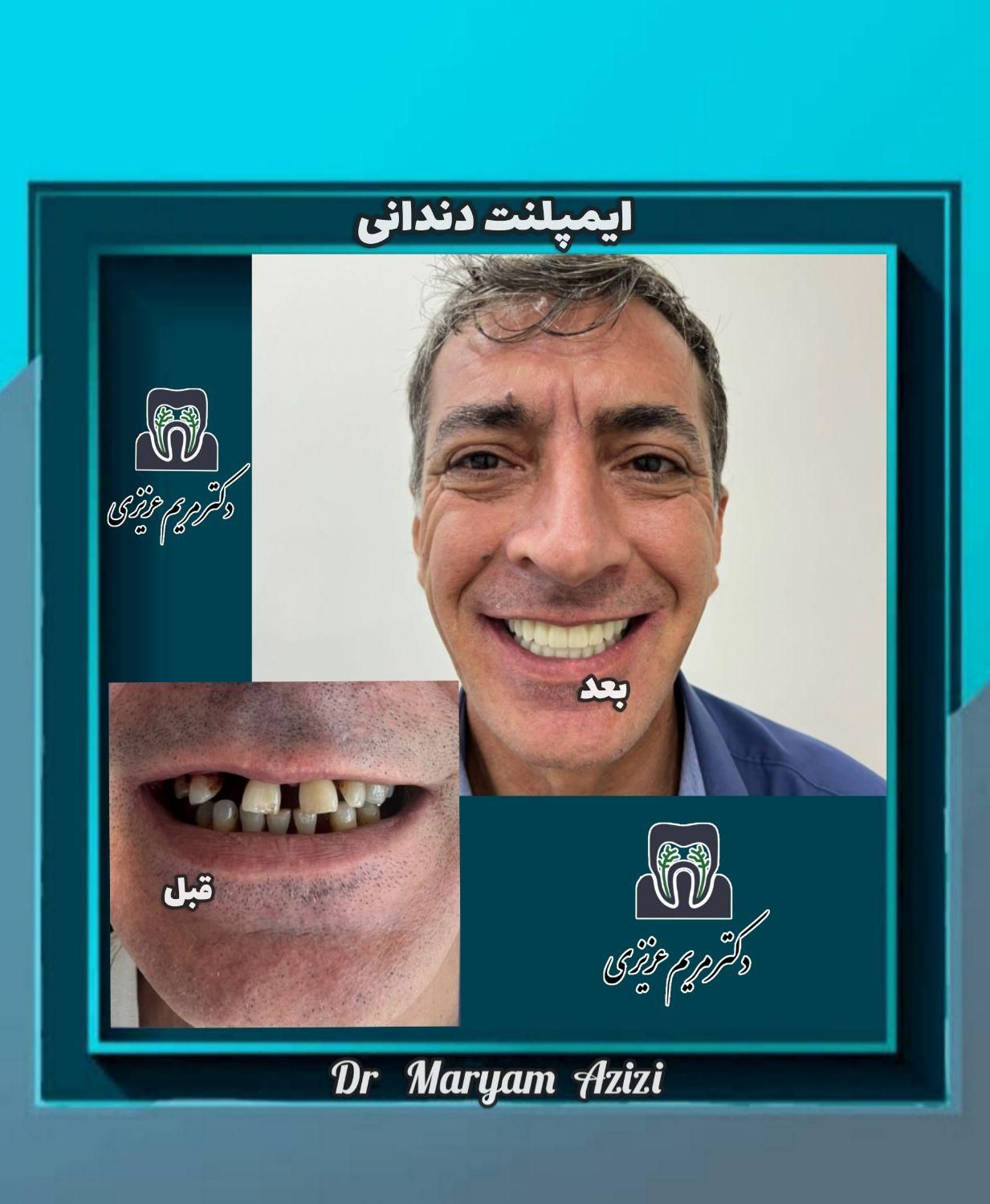 پایتخت ایمپلنت دندان دندانپزشکی تضمینی تعرفه دولتی|خدمات آرایشگری و زیبایی|شیراز, معالی‌آباد|دیوار