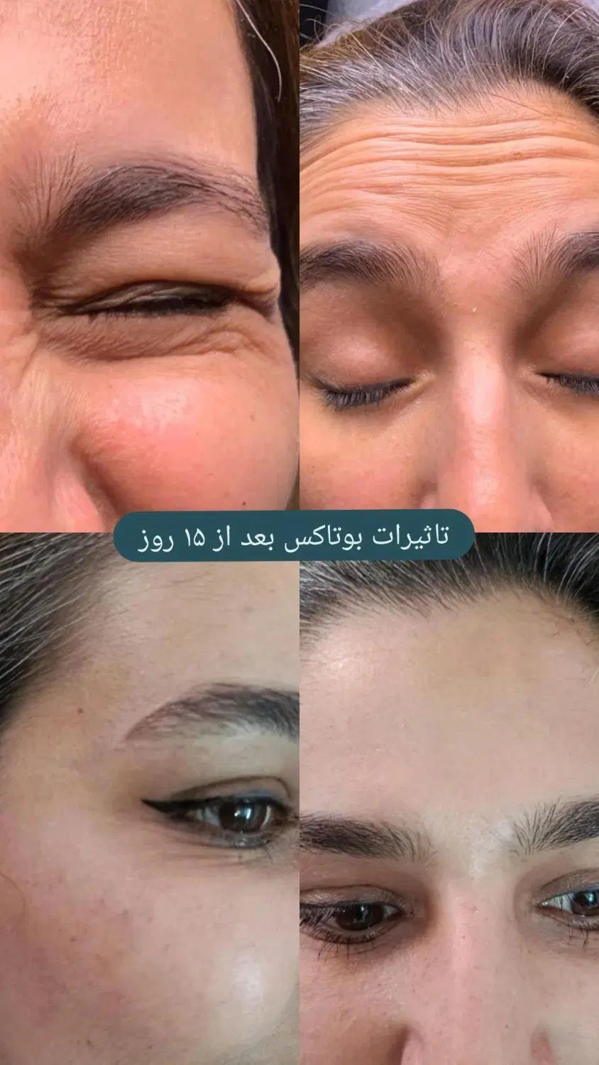 تخفیفات ویژه بوتاکس صورت و فیلر لب،فول فیس و...|خدمات آرایشگری و زیبایی|مشهد, شهید فرامرز عباسی|دیوار