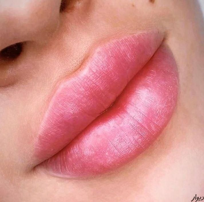 تزریق ژل لب روسی بوتاکس چشم گربه ای فیلرزیرچشم|خدمات آرایشگری و زیبایی|تهران, ستارخان|دیوار
