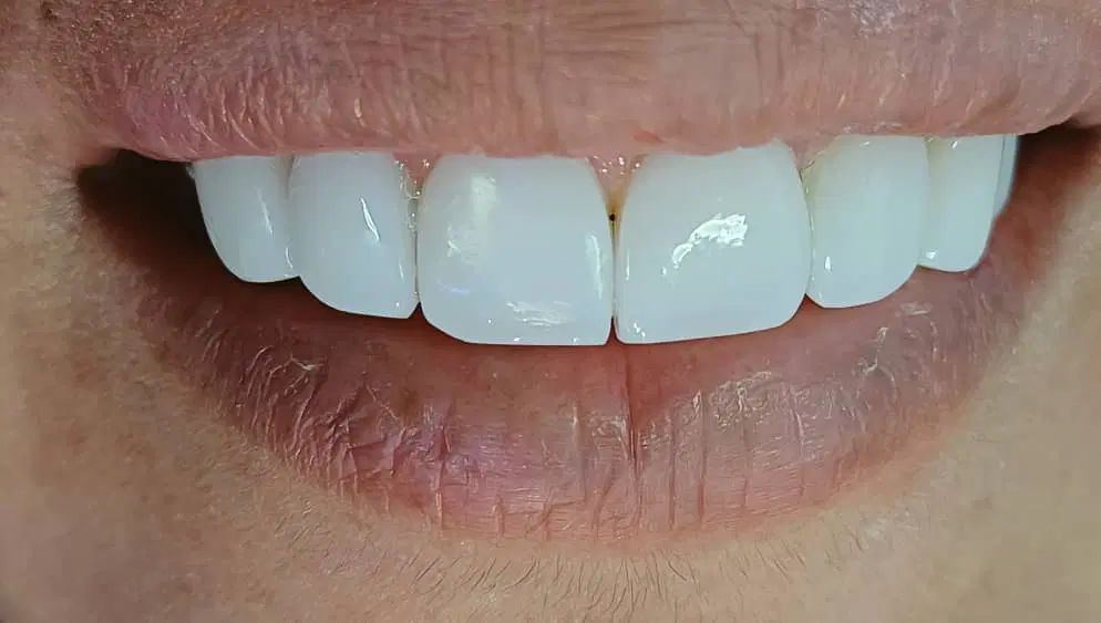 تخفیف 50 درصدی کامپوزیت و دندان پزشکی|خدمات آرایشگری و زیبایی|تهران, ایوانک|دیوار