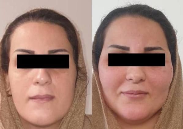 ساکشن(تخلیه) و تزریق بدن و صورت تخصصی در کلینیک|خدمات آرایشگری و زیبایی|اهواز, کیانپارس |دیوار