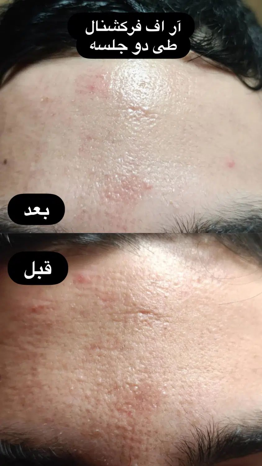 جشنواره زیبایی پوست با هایفوتراپی و آر اف فرکشنال|خدمات آرایشگری و زیبایی|قم, دورشهر|دیوار