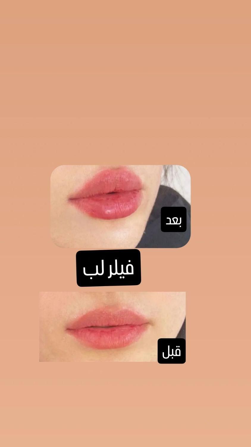 تزریق ژل با قیمت مناسب وبا کیفیت|خدمات آرایشگری و زیبایی|برازجان, |دیوار