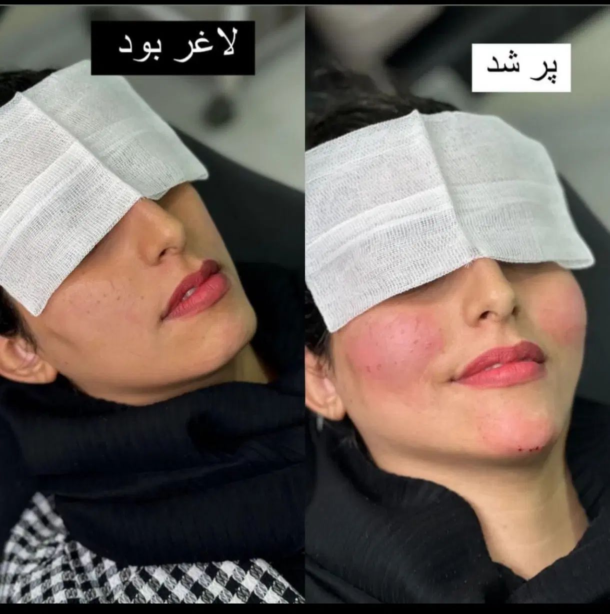فیلر ژل بوتاکس مزو لیزر هایفو فول فیس ۵۰٪ آف|خدمات آرایشگری و زیبایی|مشهد, فرهنگ|دیوار
