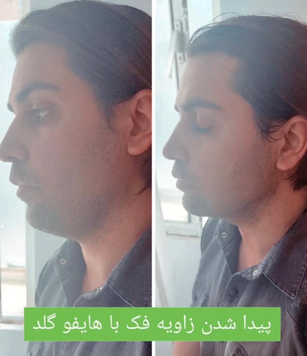 لیپوساکشن شکم و پهلو،ترنسفر به باسن،هایفودابلوگولد|خدمات آرایشگری و زیبایی|اصفهان, دشتستان|دیوار