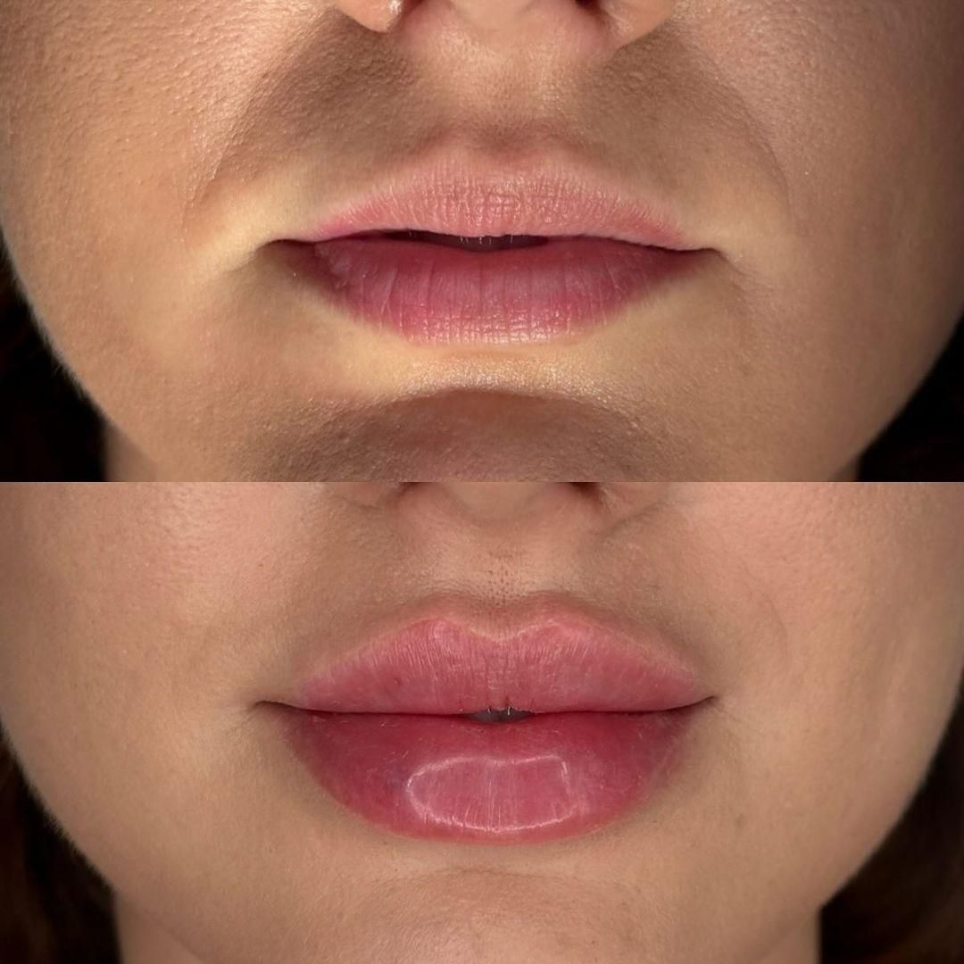 جشنواره تزریق فیلر مدت محدود فقط ۷۸۰ تومن|خدمات آرایشگری و زیبایی|زنجان, |دیوار