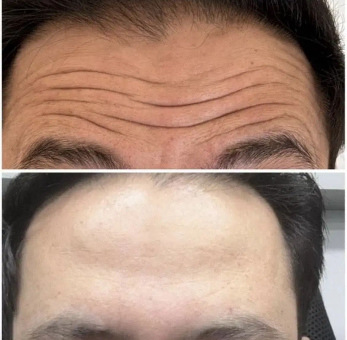 جشنواره ۵۰درصدی ژل و بوتاکس ، ساکشن غبغب|خدمات آرایشگری و زیبایی|کرمانشاه, |دیوار