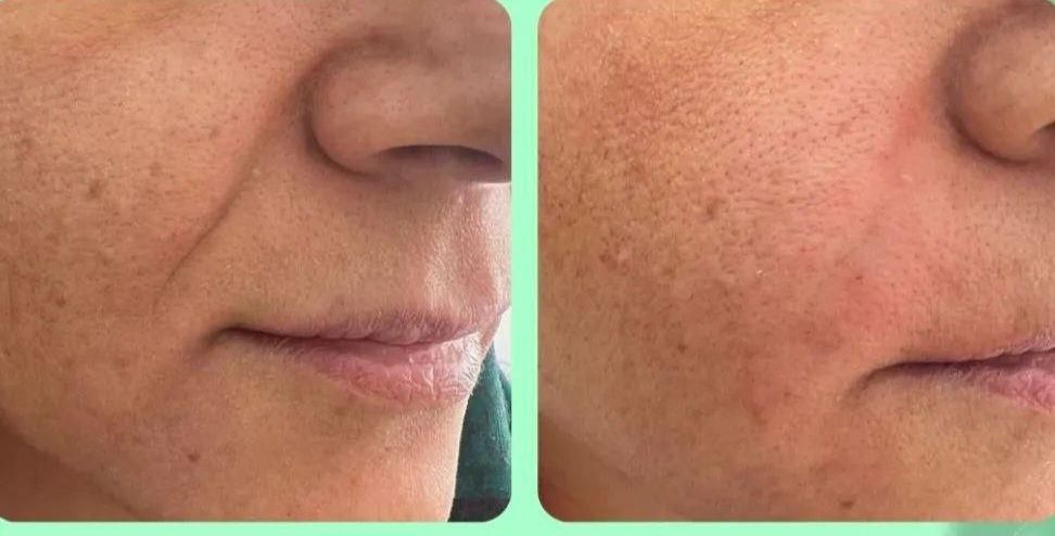 تزریق ژل بوتاکس فیلر چشم هایفو مزو جوانساز زاویه|خدمات آرایشگری و زیبایی|تهران, هفت حوض|دیوار