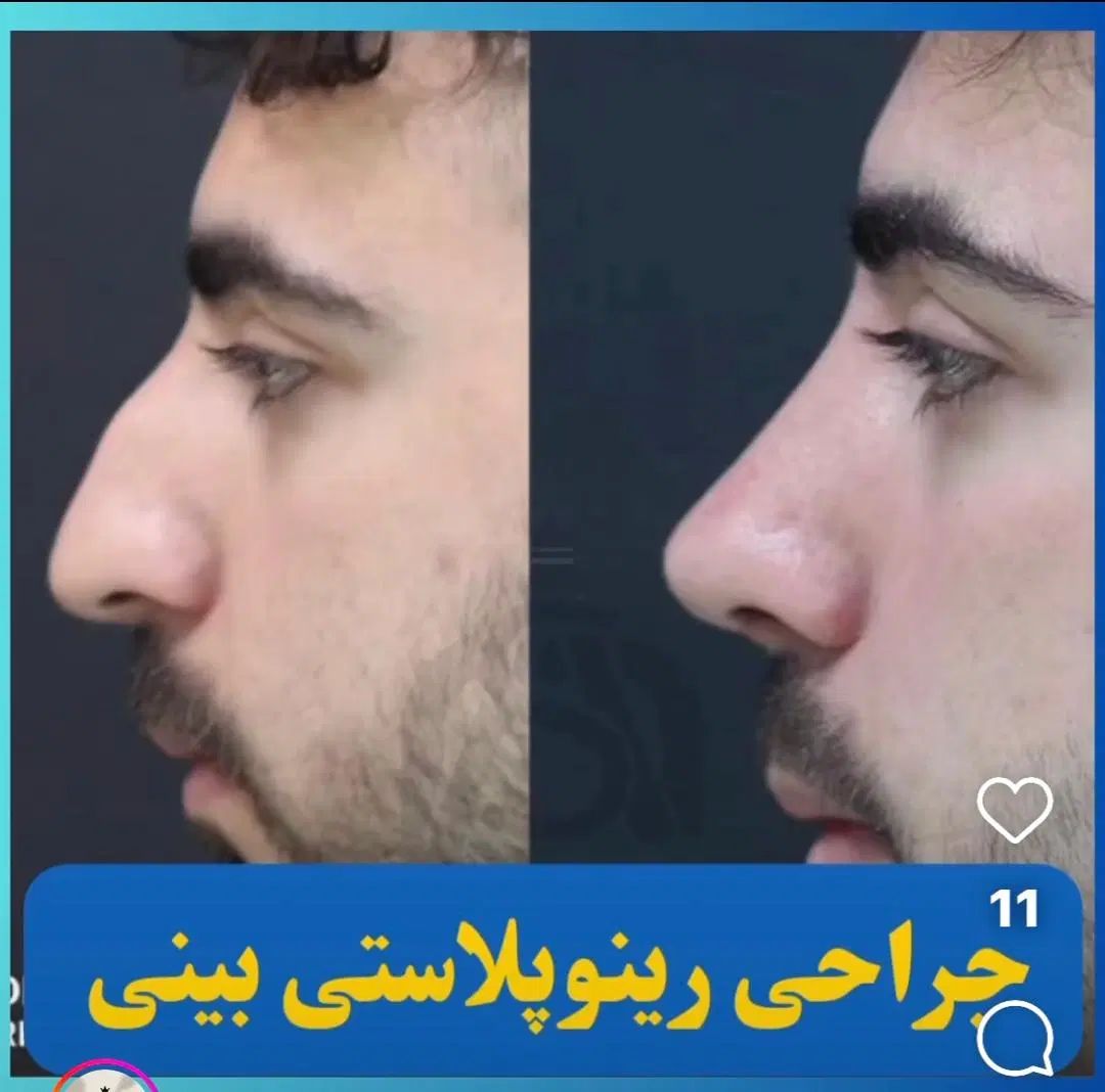 جشنواره عمل بینی جراحی بینی با ده تومن پیش|خدمات آرایشگری و زیبایی|تهران, فلسطین (میدان انقلاب)|دیوار