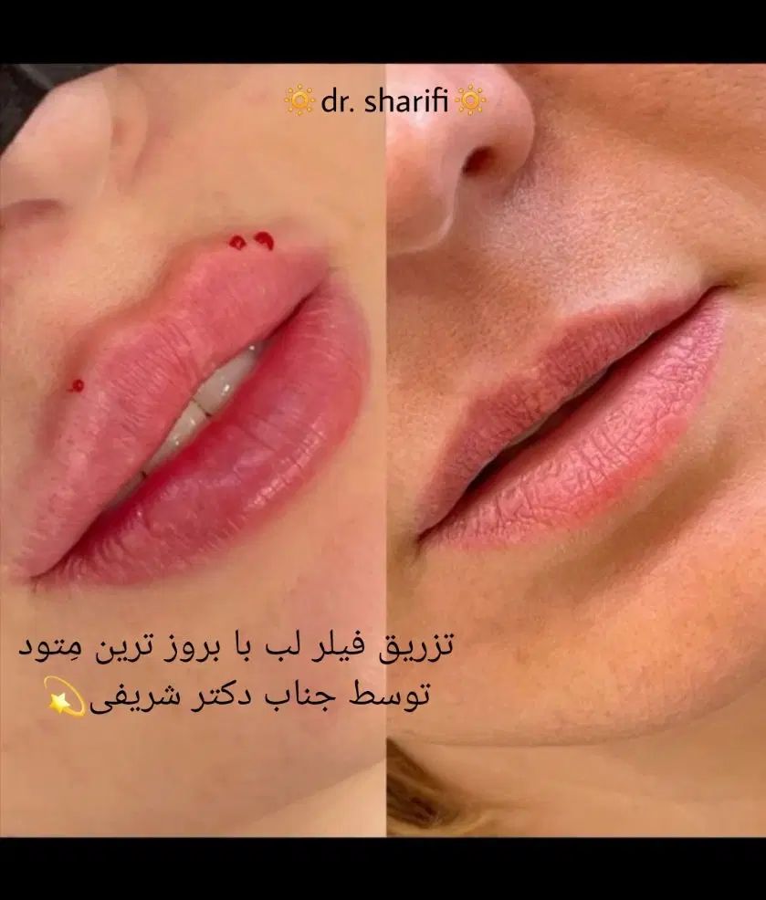 جشنواره ۵۰ درصدی ژل و بوتاکس توسط جناب دکتر شریفی|خدمات آرایشگری و زیبایی|قم, بلوار امین و ساحلی|دیوار