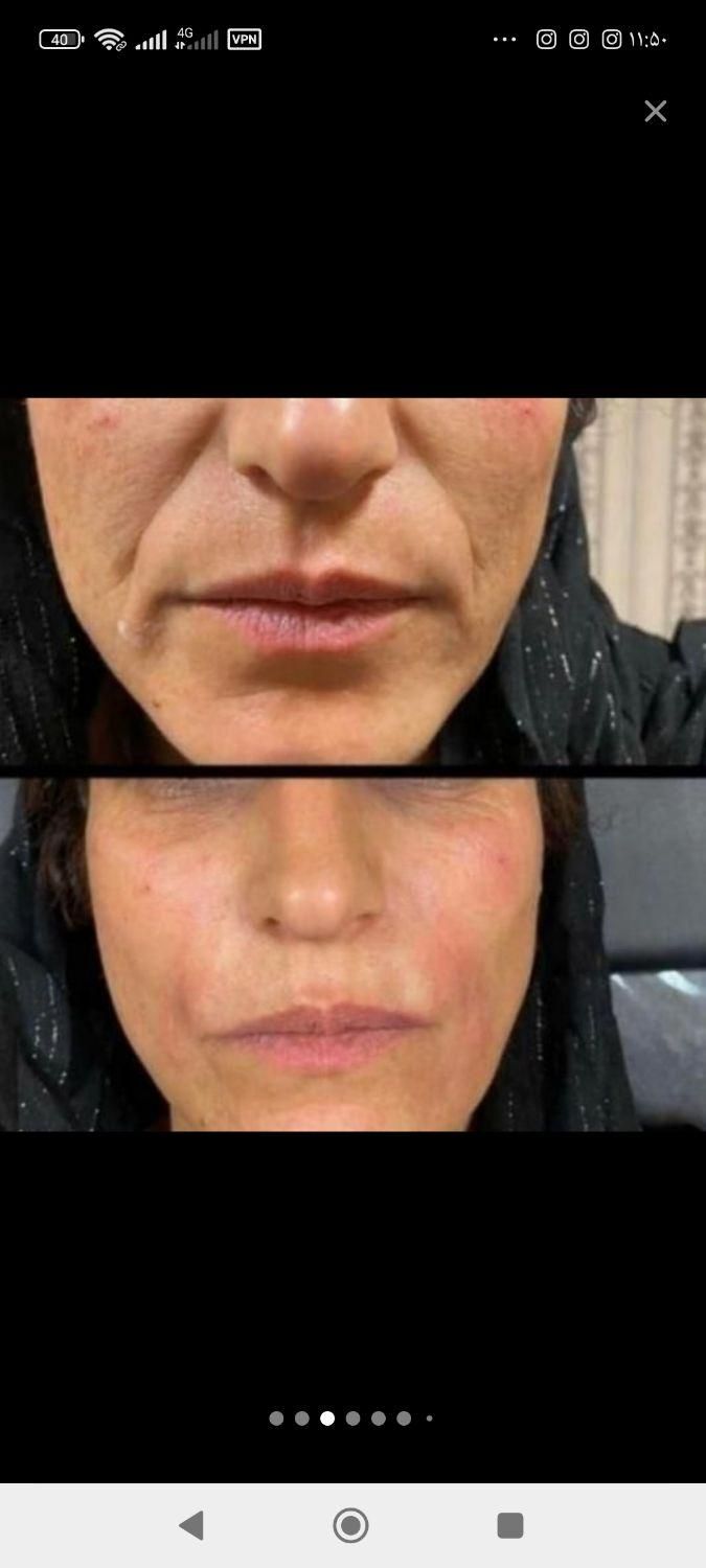 ژل لب و بوتاکس  مدلینگ پرسینگ چالگونه آموزش ژل|خدمات آرایشگری و زیبایی|اهواز, کیانپارس |دیوار