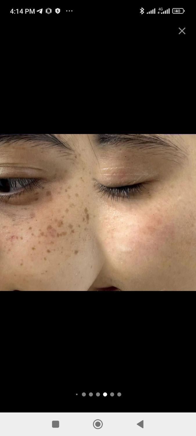 برداشت خال و لک|خدمات آرایشگری و زیبایی|تهران, گیشا|دیوار