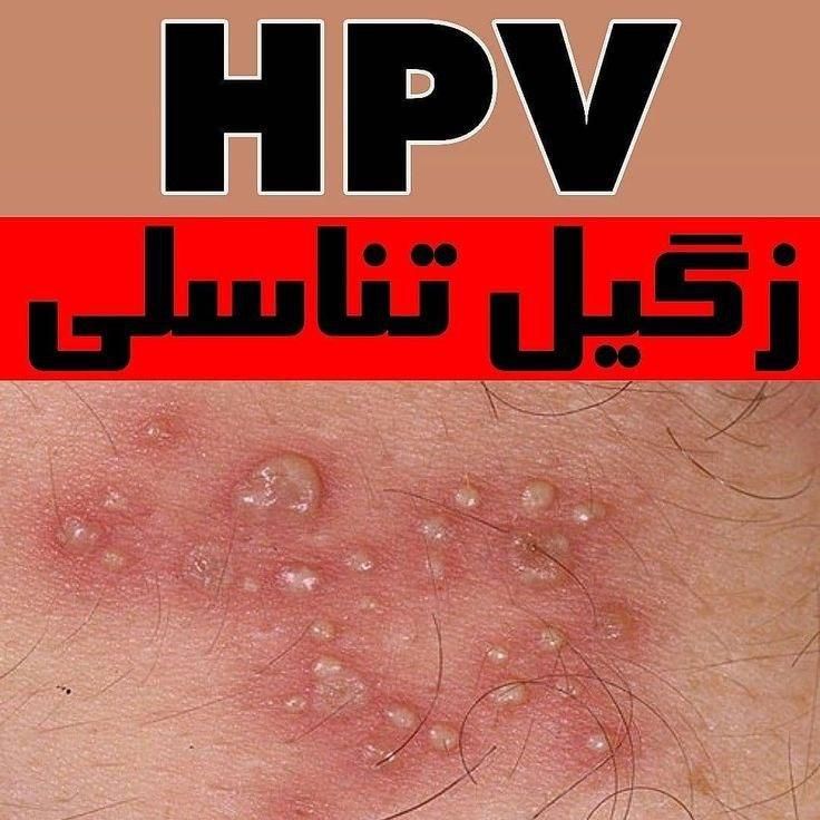 درمان زگیل تناسلی/ مشاوره Hpv|آرایشی، بهداشتی، درمانی|تهران, فرمانیه|دیوار