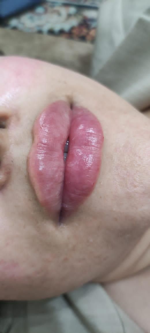 ژل و بوتاکس|خدمات آرایشگری و زیبایی|جیرفت, |دیوار