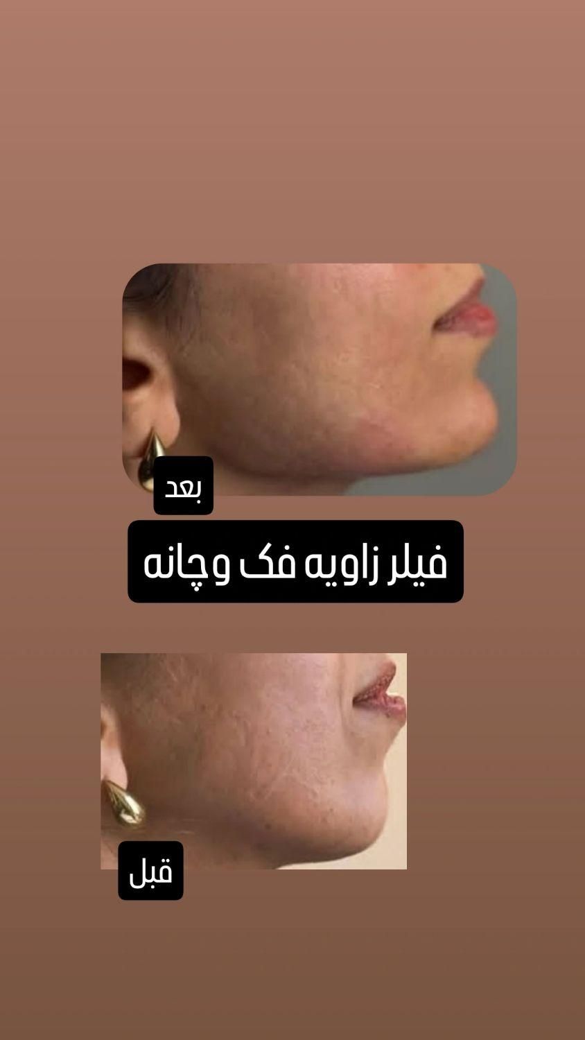 تزریق ژل وبوتاکس با بهترین قیمت در برازجان|خدمات آرایشگری و زیبایی|برازجان, |دیوار