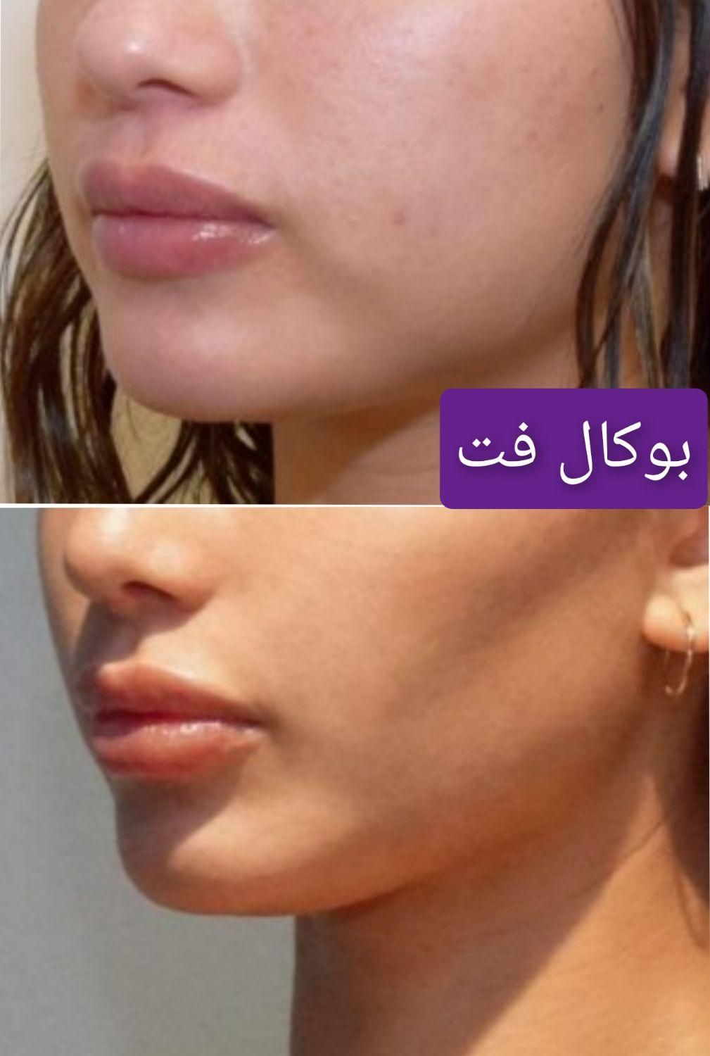 غبغب بوکال لیفت شقیقه سانترال چربی ژل بوتاکس|خدمات آرایشگری و زیبایی|شیراز, قدوسی غربی|دیوار
