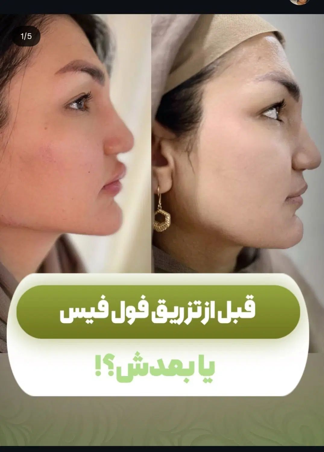 خدمات ژل و بوتاکس|خدمات آرایشگری و زیبایی|مشهد, سجاد شهر|دیوار