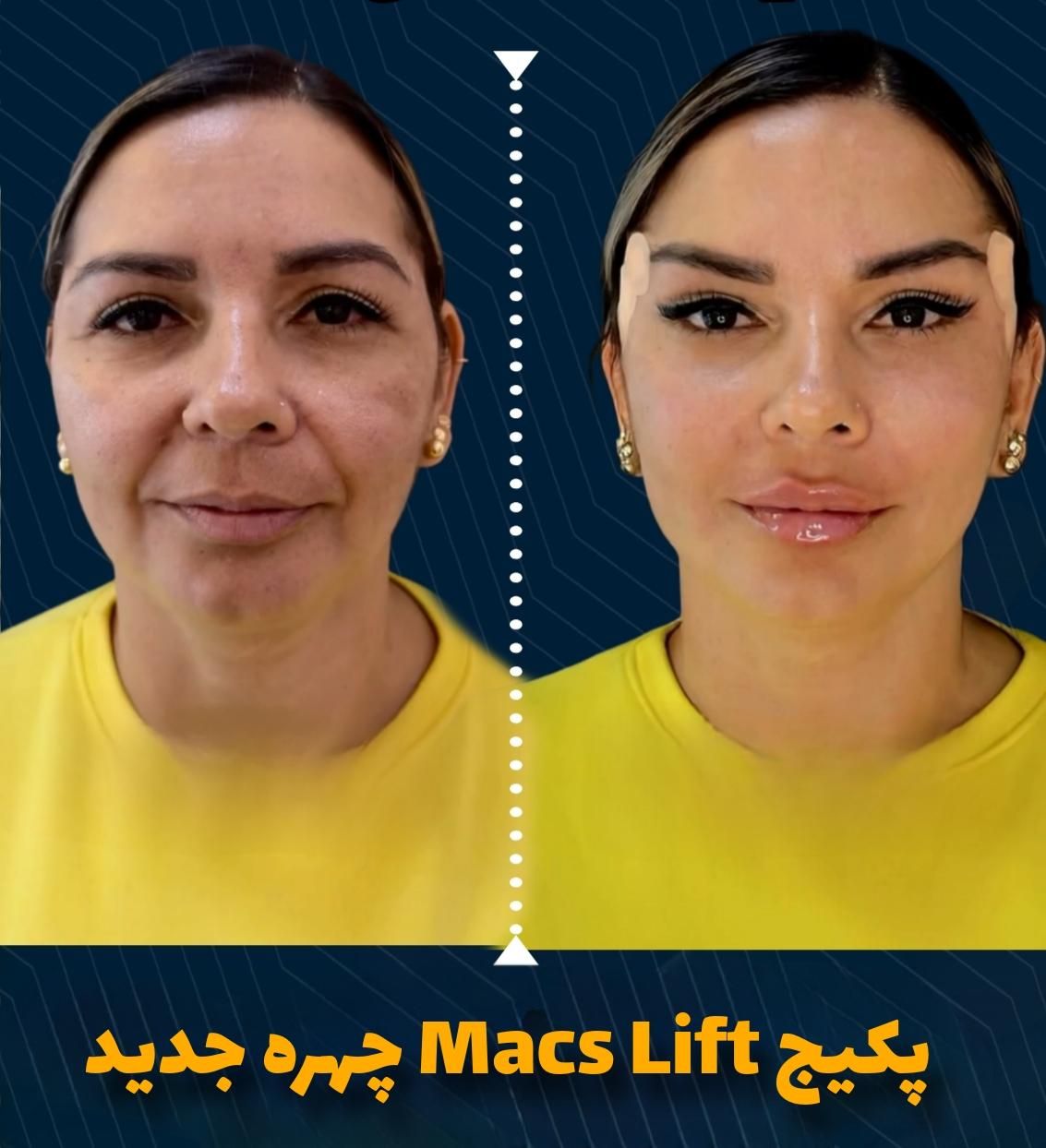 جشنواره کانتورینگ Pro Face بدون جراحی و بیهوشی|خدمات آرایشگری و زیبایی|مشهد, هفت تیر (حافظ)|دیوار
