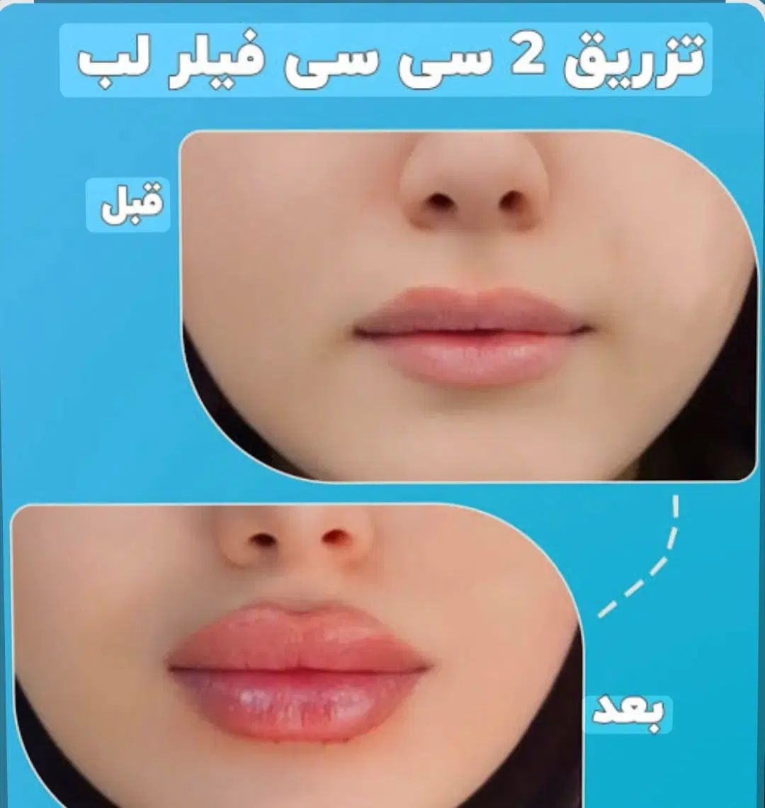 50٪تخفیف خدمات فیلر بوتاکس مزوتراپی پرسینگ چال لپ|خدمات آرایشگری و زیبایی|اصفهان, مولوی|دیوار