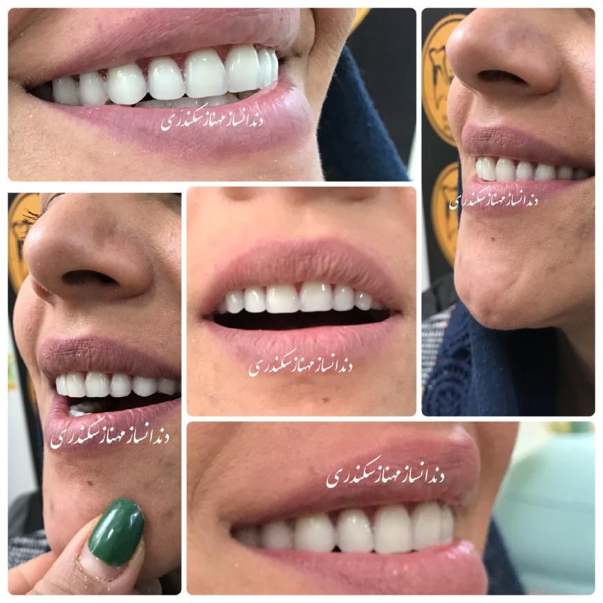 دندانسازی سکندری کرمان دندان ایتالیایی لثه نرم|خدمات آرایشگری و زیبایی|کرمان, |دیوار