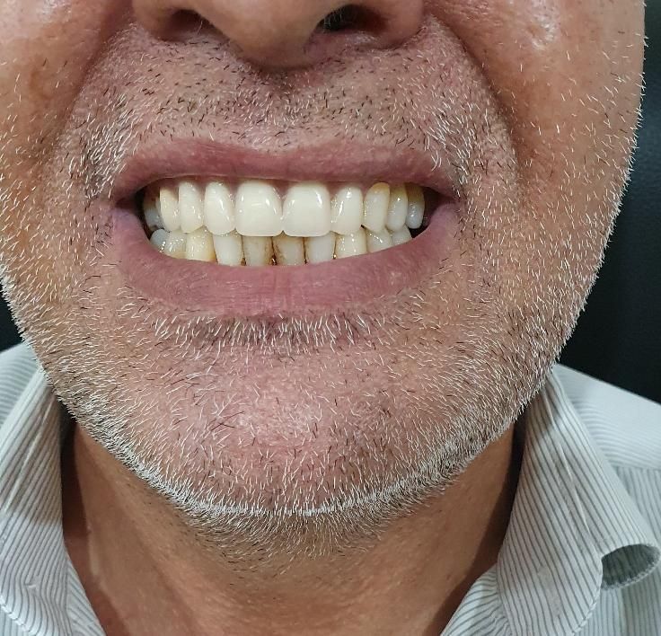 دندانسازی (ساخت دندان مصنوعی تعمیر دندان مصنوعی )|خدمات آرایشگری و زیبایی|تهران, مشیریه|دیوار