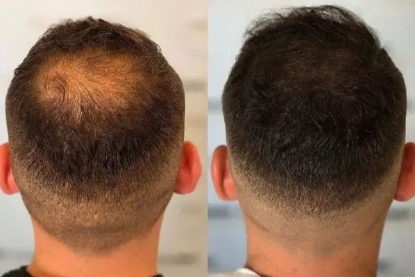 آموزش و خدمات میکرواسکالپ ،اسکراب ،مکمل کاشت مو|خدمات آرایشگری و زیبایی|مشهد, صیاد شیرازی|دیوار