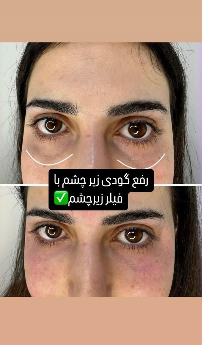 تزریق ژل و بوتاکس در شرق تهران|خدمات آرایشگری و زیبایی|تهران, نظام‌آباد|دیوار