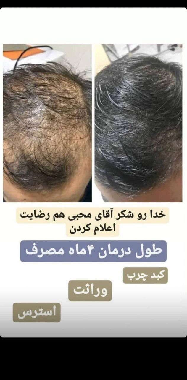 مشاوره ریزش مو و رویش مجدد|خدمات آرایشگری و زیبایی|مشهد, کلاهدوز|دیوار