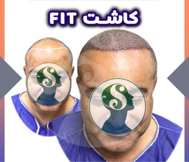 کاشت موی شیرازی|خدمات آرایشگری و زیبایی|تهران, سعادت‌آباد|دیوار