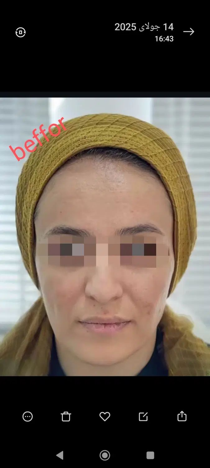 بوتاکس رایگان با انجام دو سی سی فیلر پیروزی|خدمات آرایشگری و زیبایی|تهران, چهارصد دستگاه|دیوار
