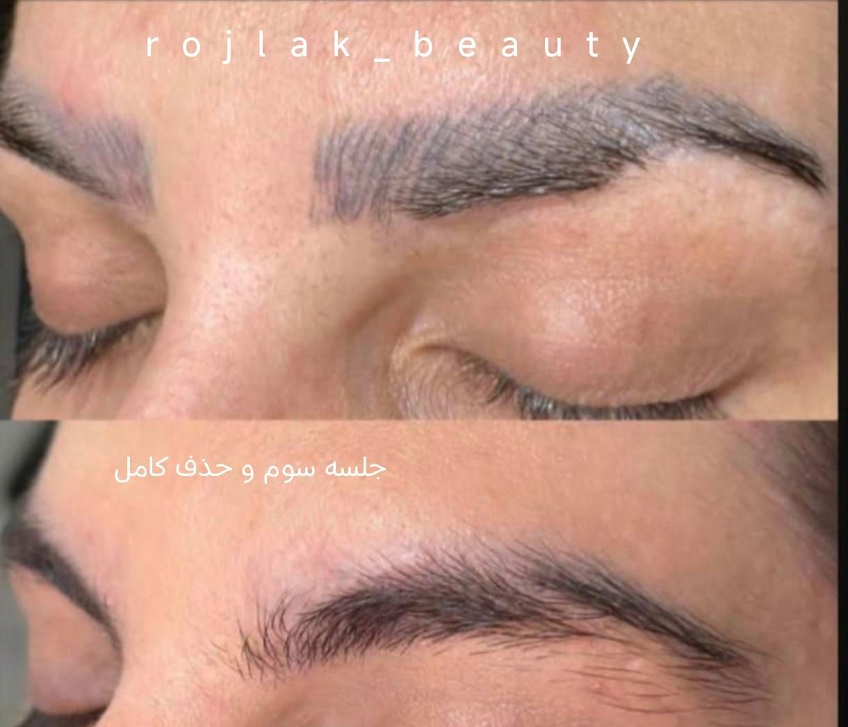 پاک کردن تتو و خالکوبی با لیزر کیوسوییچ پیکوشور|خدمات آرایشگری و زیبایی|مشهد, فرودگاه|دیوار