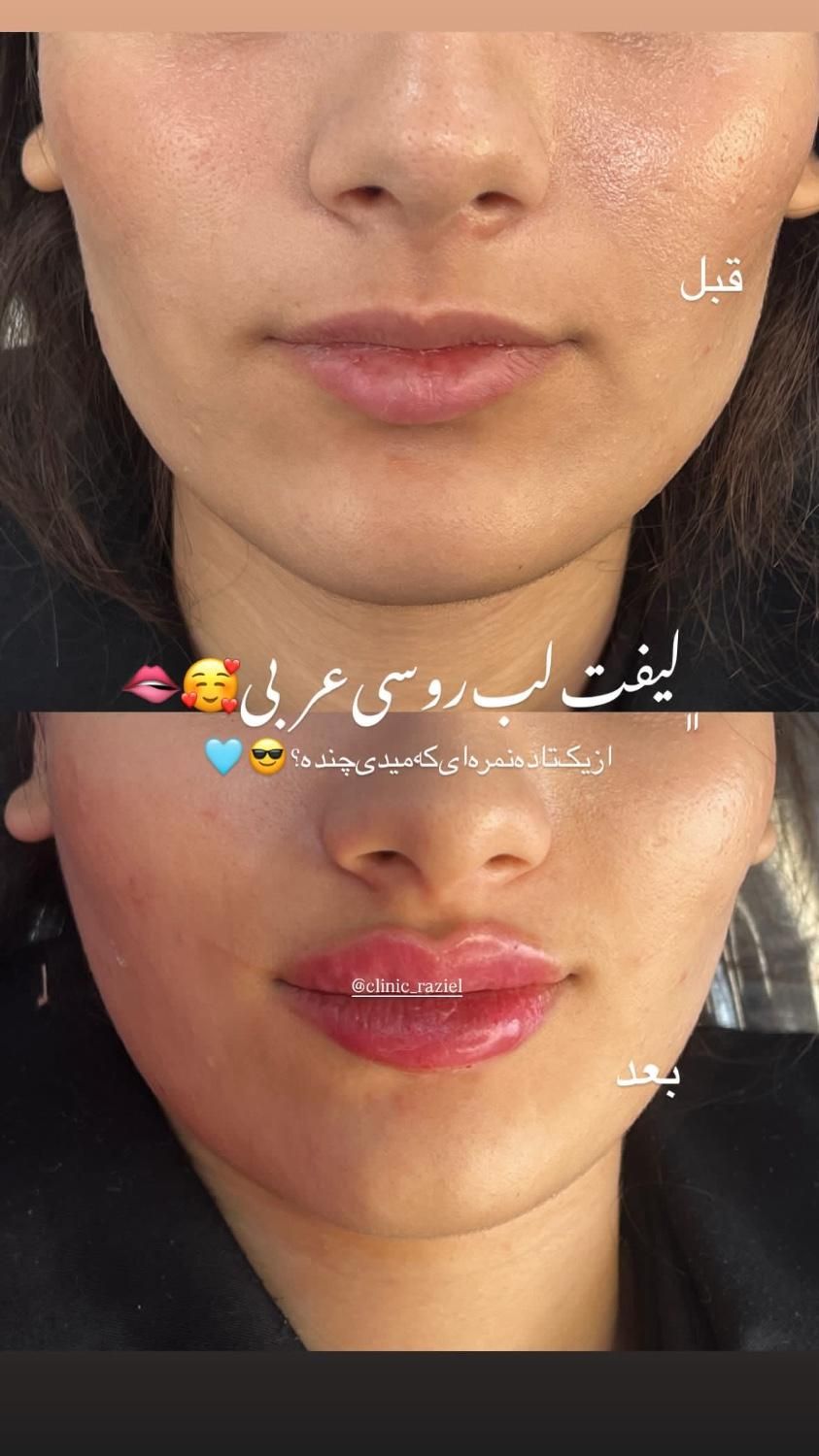 تخفیفات استثنایی ژل و بوتاکس در مطب زیبایی|خدمات آرایشگری و زیبایی|قم, زنبیل آباد|دیوار