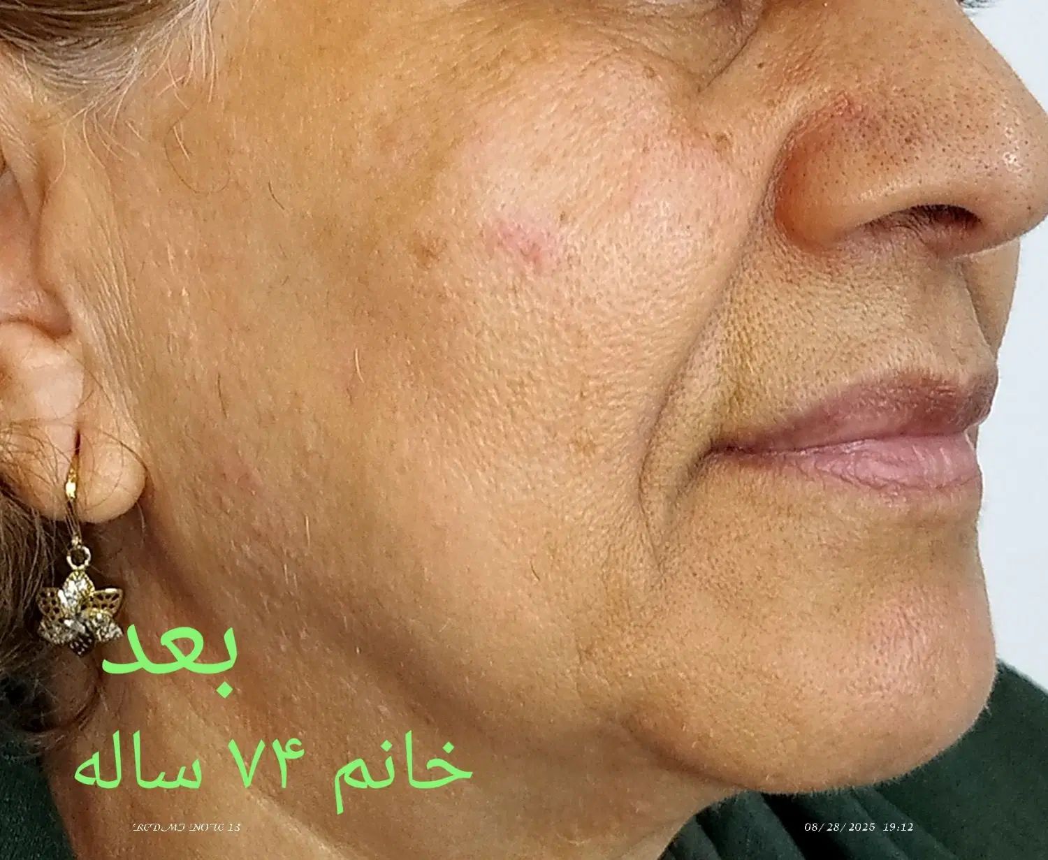 لیفت وجوانسازی قوی صورت|خدمات آرایشگری و زیبایی|رشت, گلسار|دیوار