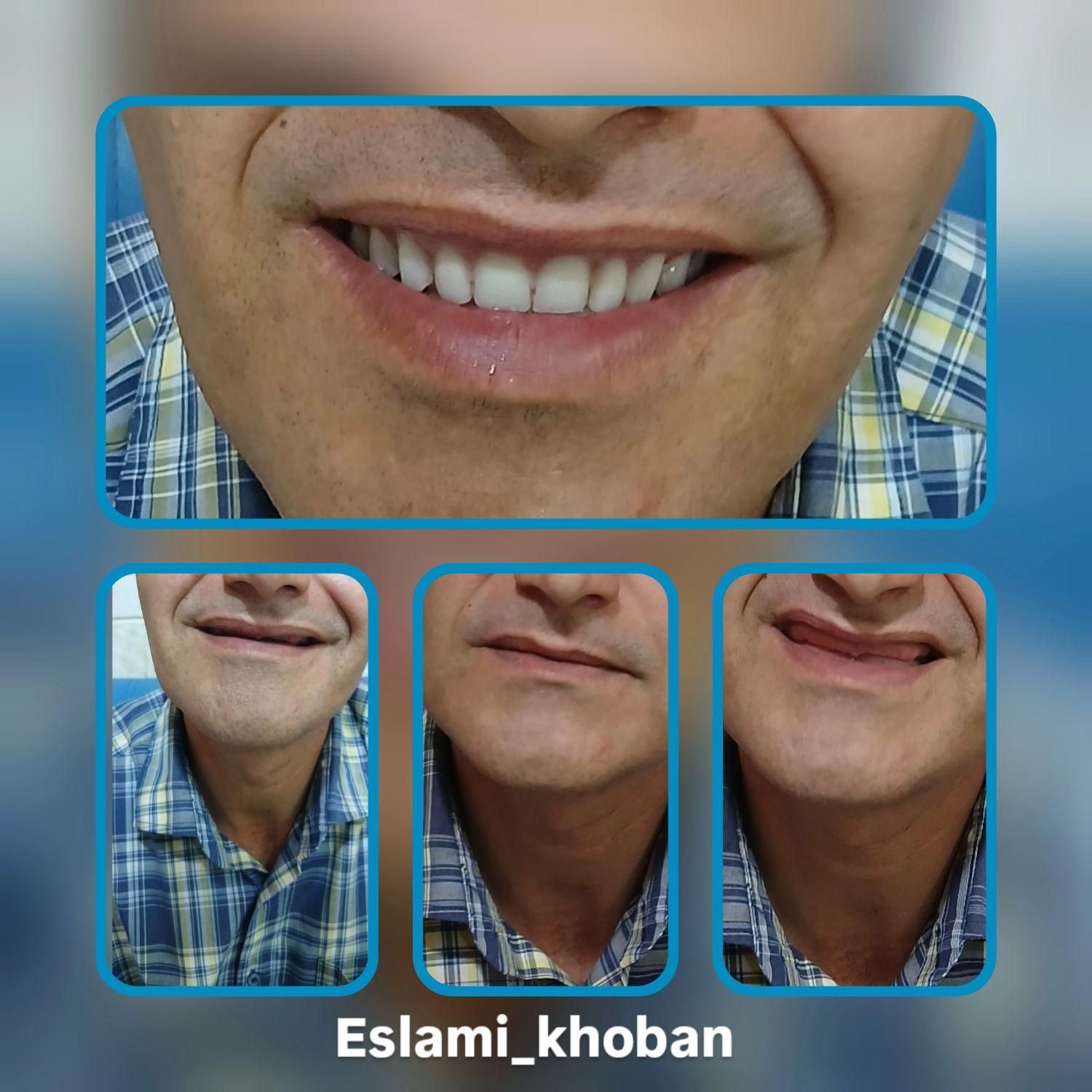 خدمات تخصصی پروتز متحرک(دندان مصنوعی)|خدمات آرایشگری و زیبایی|قزوین, |دیوار