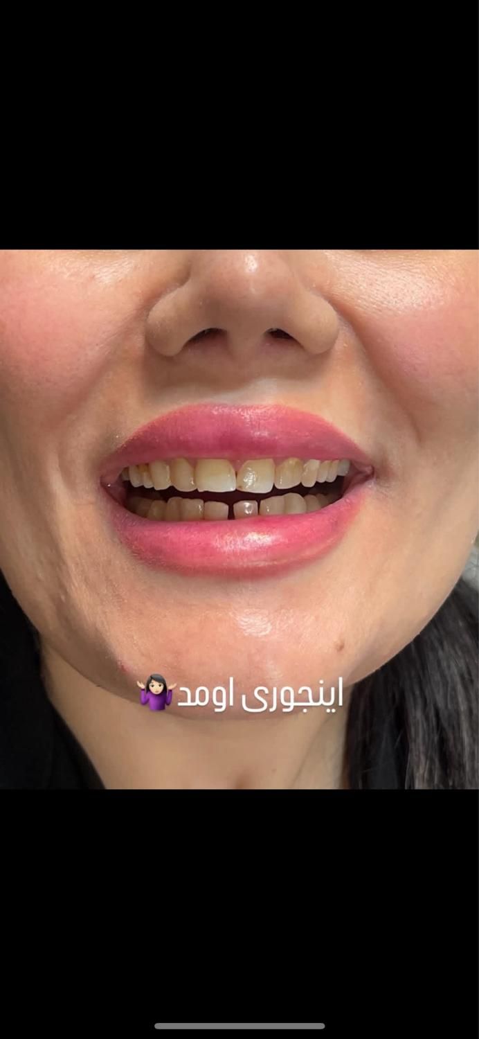 کامپوزیت دندان|خدمات آرایشگری و زیبایی|اهواز, نادری|دیوار