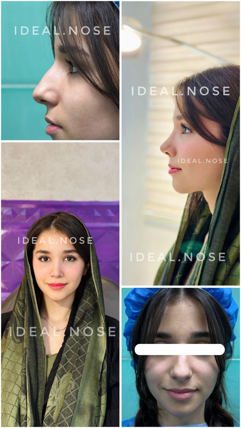 جشنواره عمل زیبایی بینی با تخفیف ویژه|خدمات آرایشگری و زیبایی|الوند, |دیوار