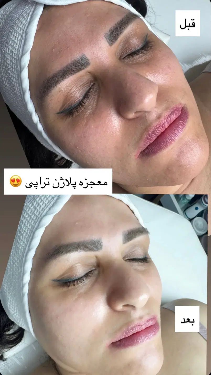 پلاژن تراپی /هایفو تراپی /لیزر بدن/کربوکسی|آرایشگاه و سالن‌های زیبایی|مشهد, کارگران|دیوار