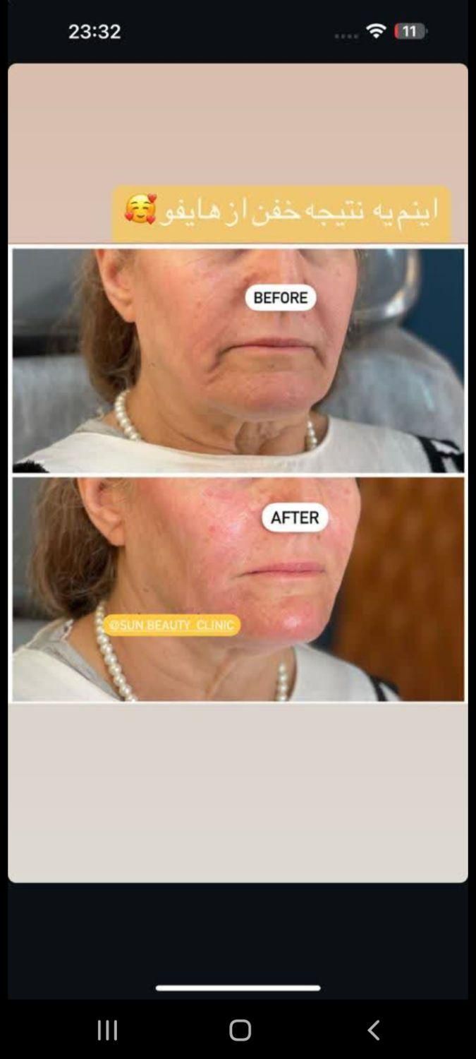 هایفوتراپی14بعدی برای نخستین بار در غرب کشور|خدمات آرایشگری و زیبایی|خرم‌آباد, |دیوار