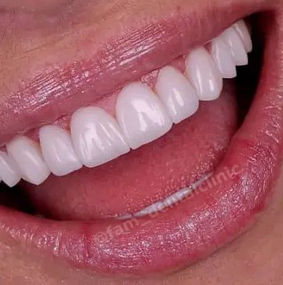 کامپوزیت دندان/اقساط/آف ویژه|خدمات آرایشگری و زیبایی|اصفهان, جلفا|دیوار