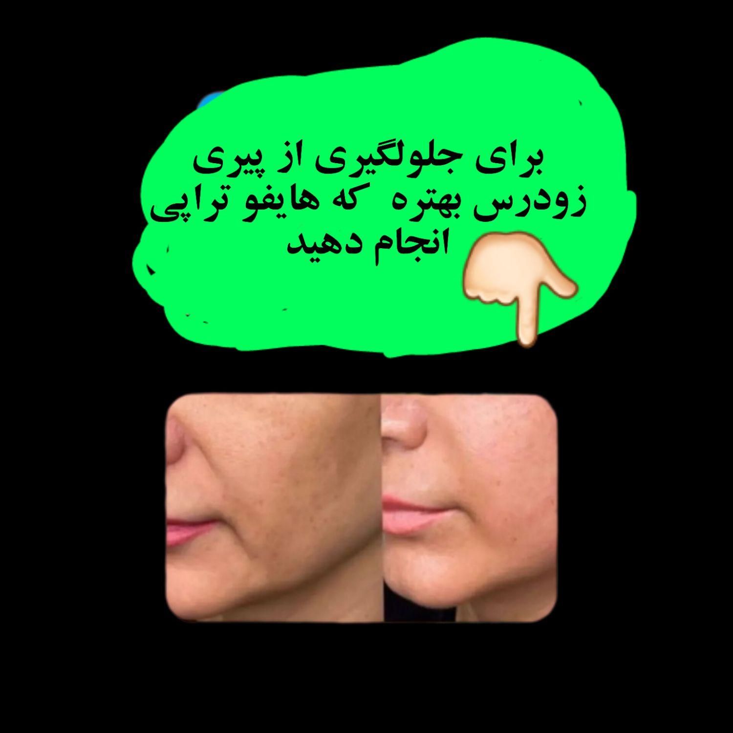 لیزر موهای زائد صورت وبدن،  جوانسازی پوست|خدمات آرایشگری و زیبایی|رفسنجان, |دیوار