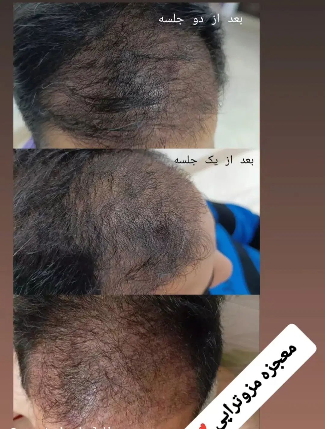 جشنواره مزوتراپی وبوتاکس به مناسبت افتتاح مطب پزشک|خدمات آرایشگری و زیبایی|قم, بکایی|دیوار